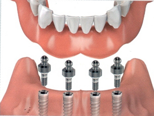 protesi impianti dentista dentiera overdenture toronto